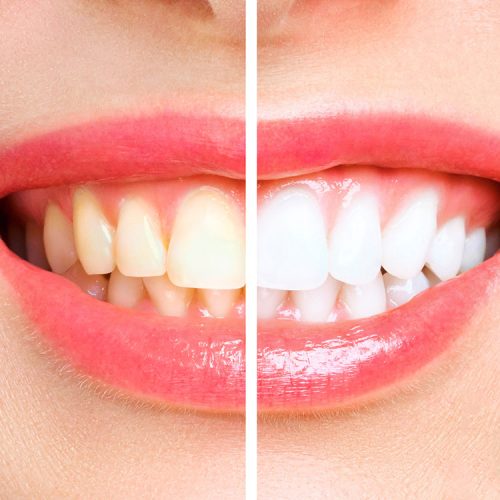 Zahnästhetik – Bleaching Bild Zahnästhetik - Bleaching